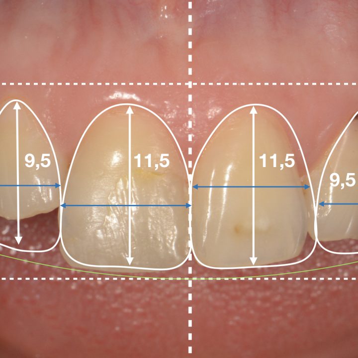 Jak przebiega proces tworzenia licówek na zęby?