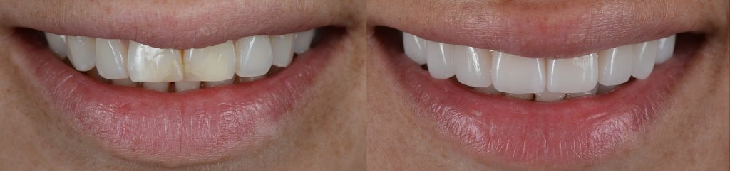 Licówki zębowe przed i po