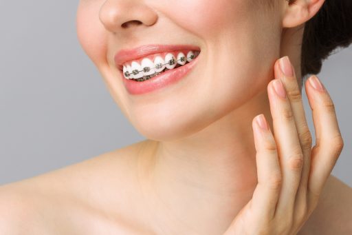 Jak działa aparat ortodontyczny ?