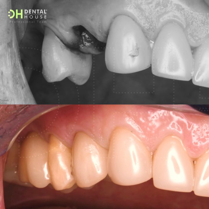 Implant – najlepsza odbudowa brakującego zęba
